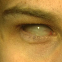 VCP: Eye Replacement